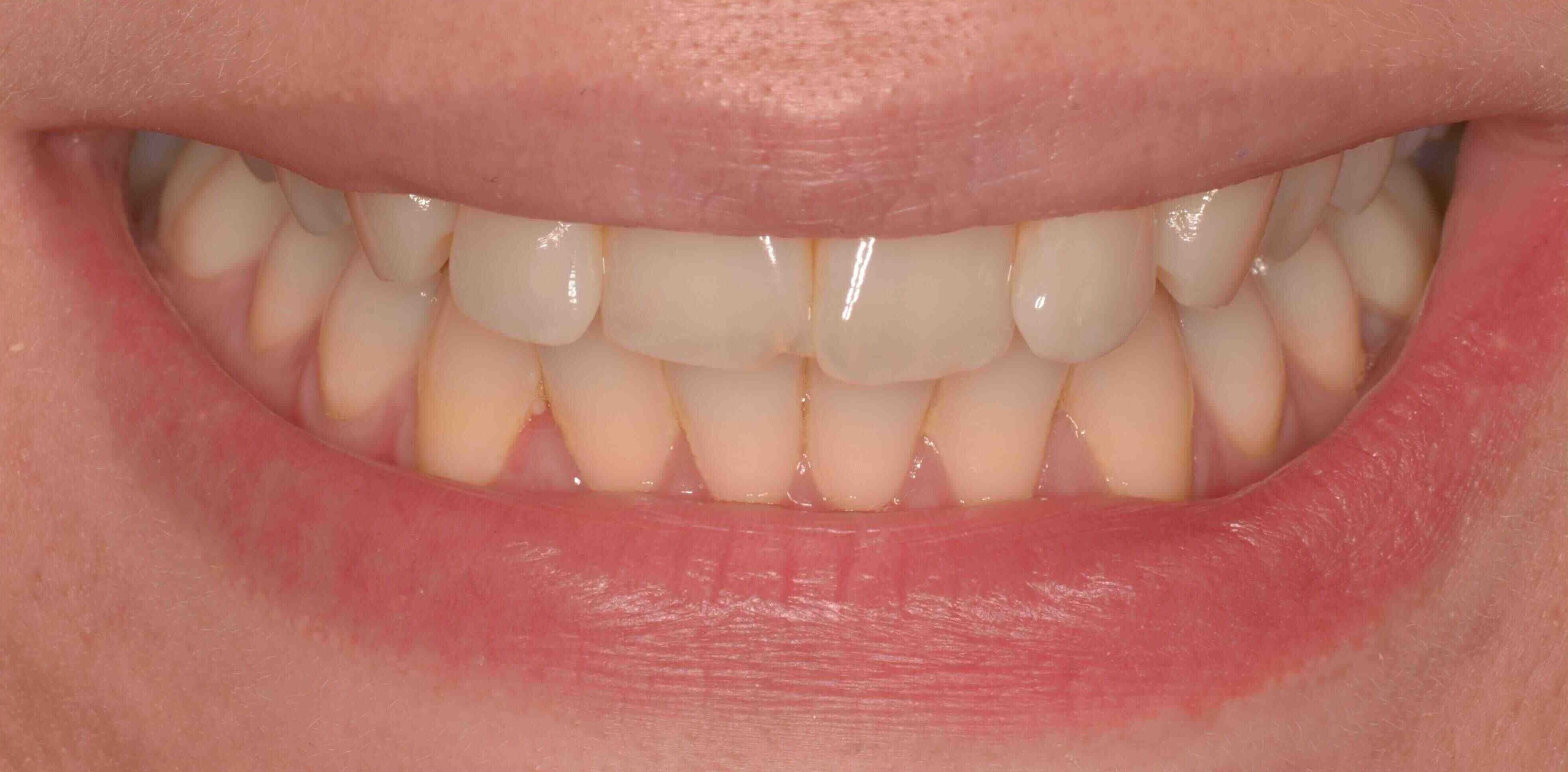 Invisalign and whitening transformation